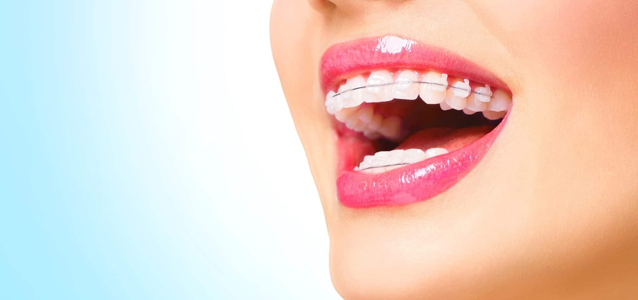 Invisalign Incognito Ourense