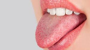 Xerostómía. Boca Seca