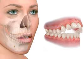 degluación atípica