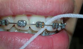 Uso de hilo dental durante la ortodoncia con brackets