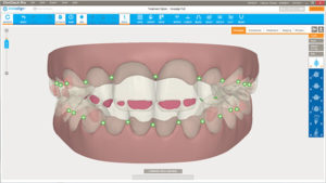 Ortodoncia Invisalign