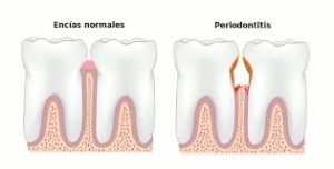 Periodontitis y Cáncer