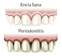 Periodontitis y riesgo de ictus