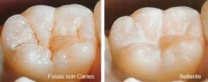 Sellado Dental